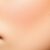Melasma: przyczyny, objawy i skuteczne metody leczenia
